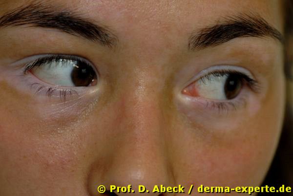 Vitiligo mit Befall der Periokularregion